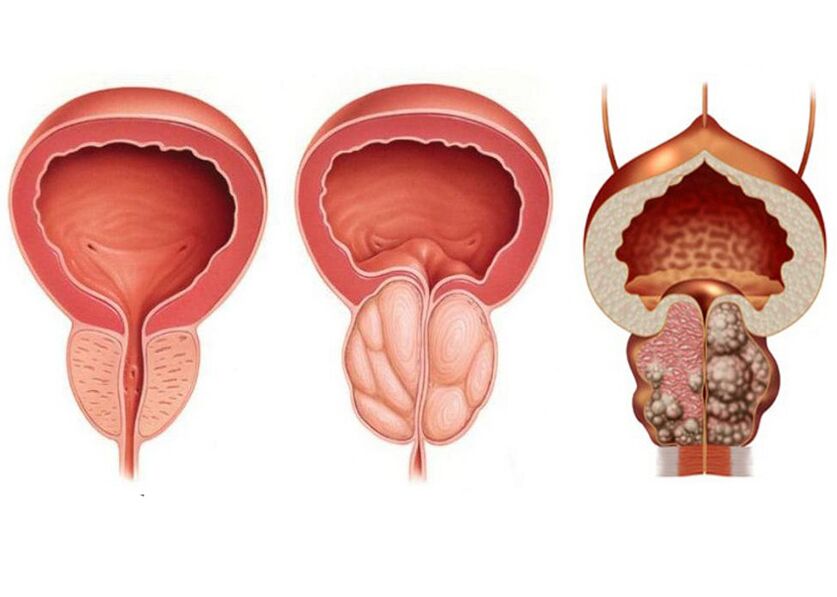 Fase di prostatite e la necessità di usare pienamente la prostavit
