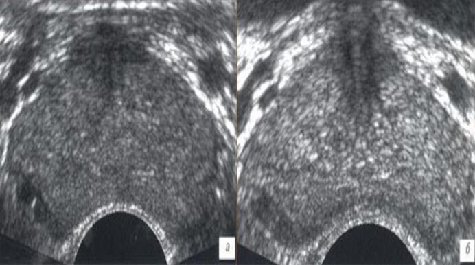 Ultrasuoni prima e dopo il trattamento con gocce Prostovit